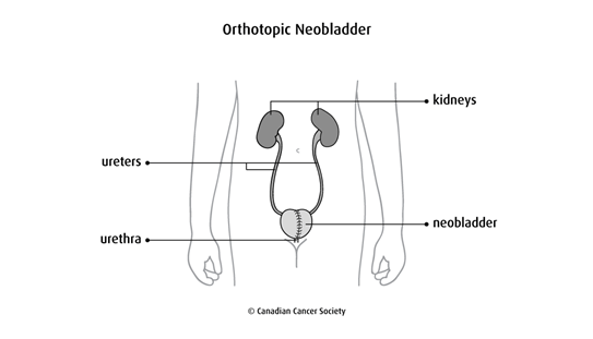 Diagram of an orthotopic neobladder