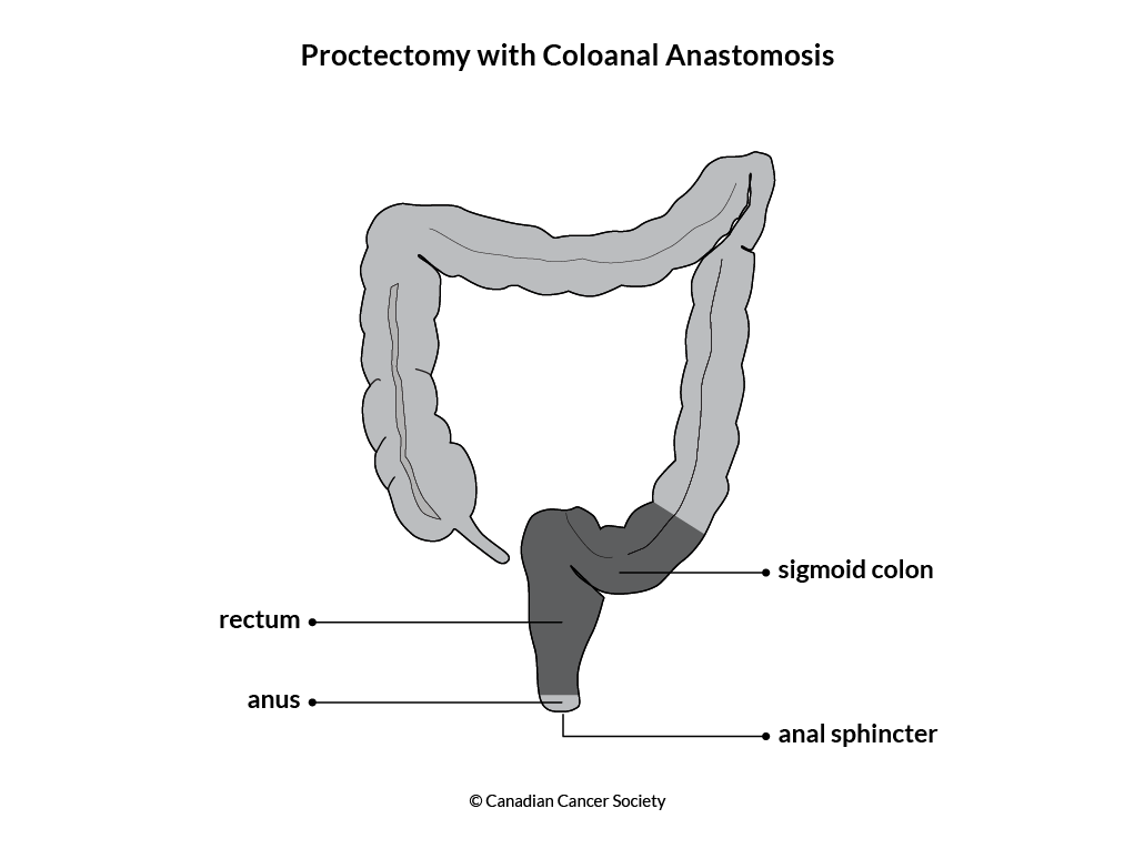 Diagram of a proctectomy with coloanal anastomosis