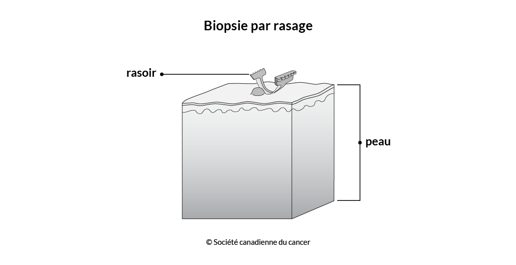 Schéma de la biopsie par rasage