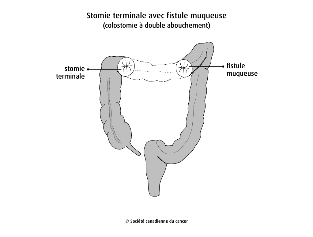 Stomie avec fistule muqueuse
