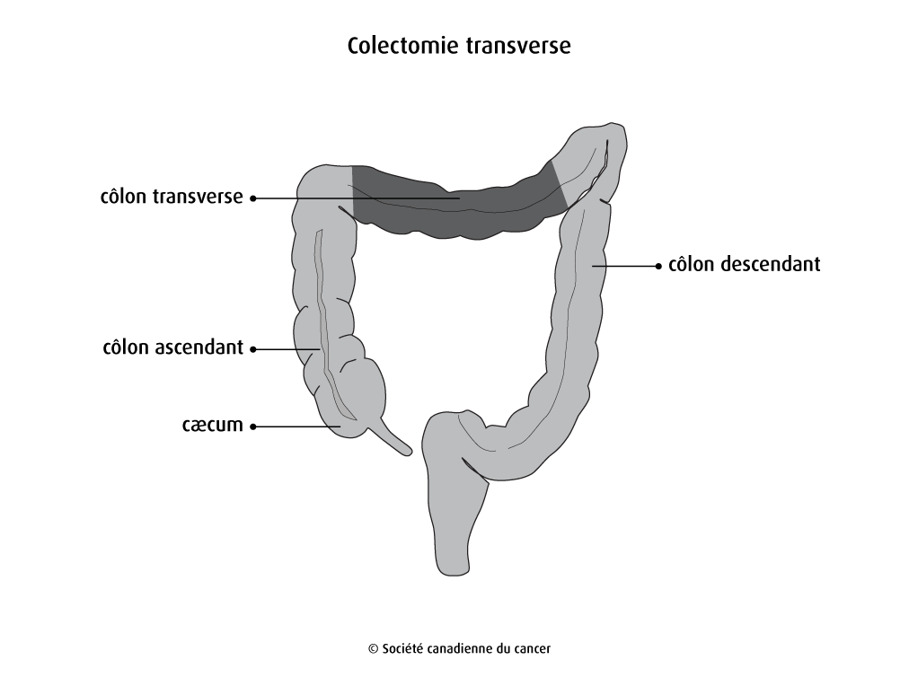 Schéma de la colectomie transverse