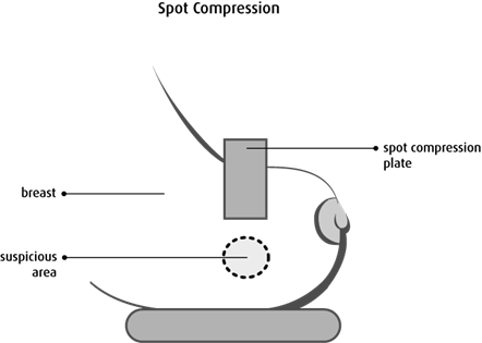Mammography | Canadian Cancer Society