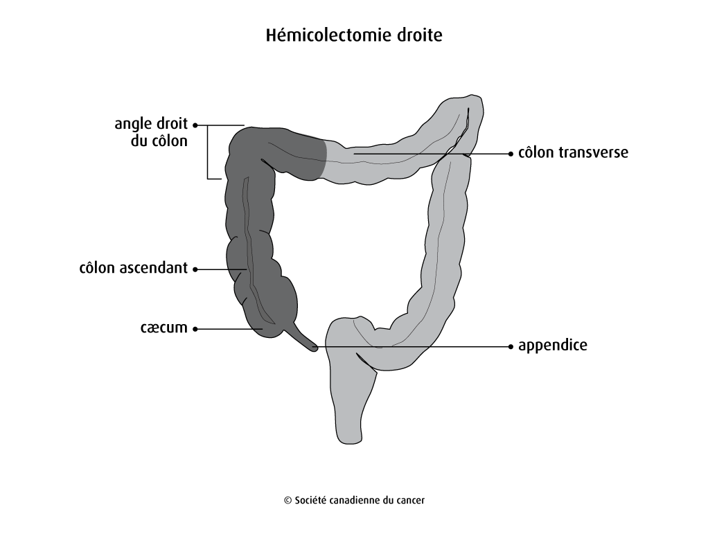 Schéma de l’hémicolectomie droite