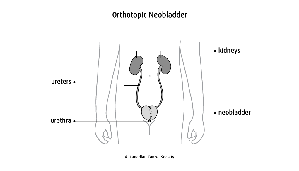 Diagram of an orthotopic neobladder