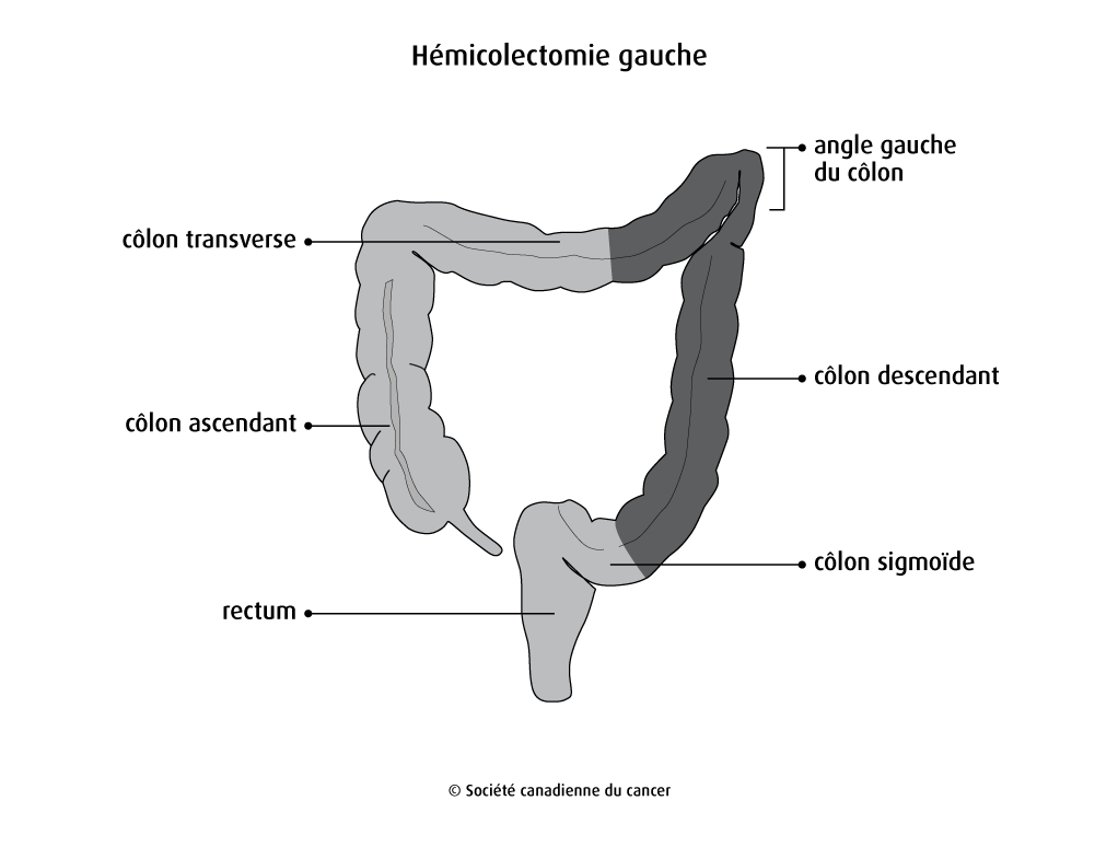Schéma de l’hémicolectomie gauche