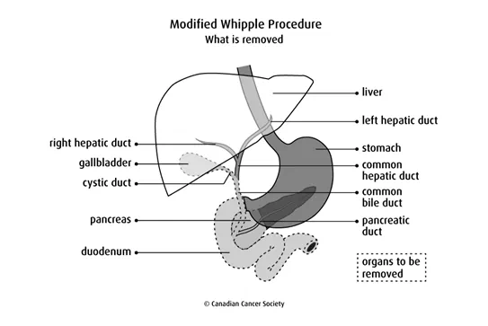 Diagram of Modified Whipple Procedure and what is removed