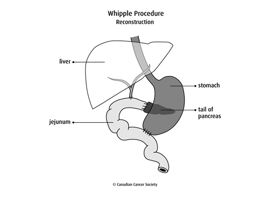 Diagram of Whipple Procedure reconstruction