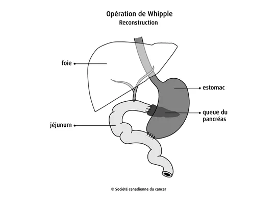 Schéma de l'opération de Whipple, reconstruction