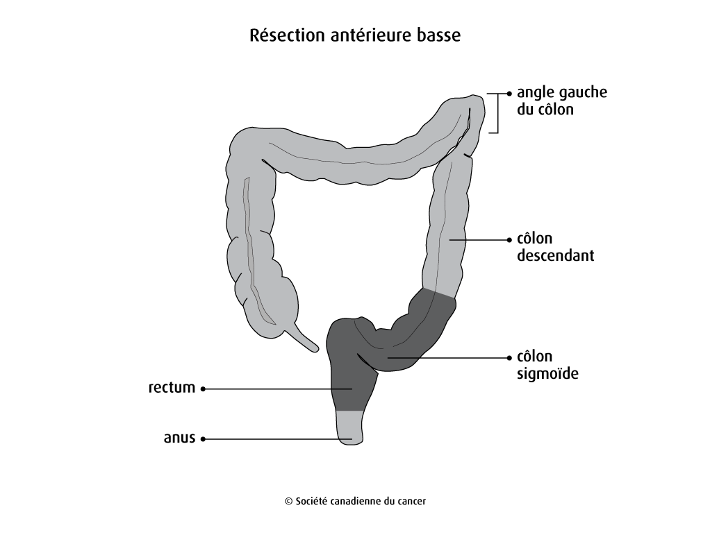 Schéma de la résection antérieure basse