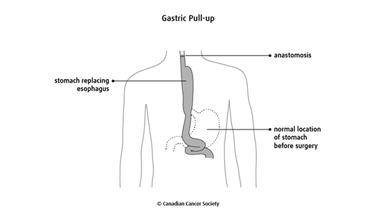 Diagram of a gastric pull-up