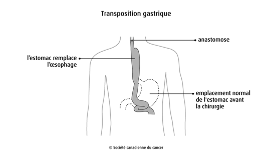 Schéma de la transposition gastrique