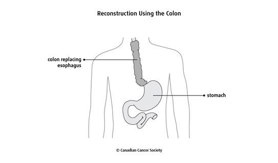 Diagram of reconstruction using the colon