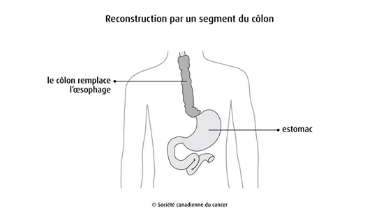 Schéma de la reconstruction par un segment du côlon
