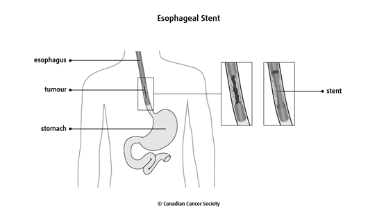 Diagram of an esophageal stent