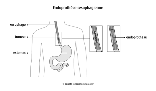 Schéma d'une endoprothèse œsophagienne