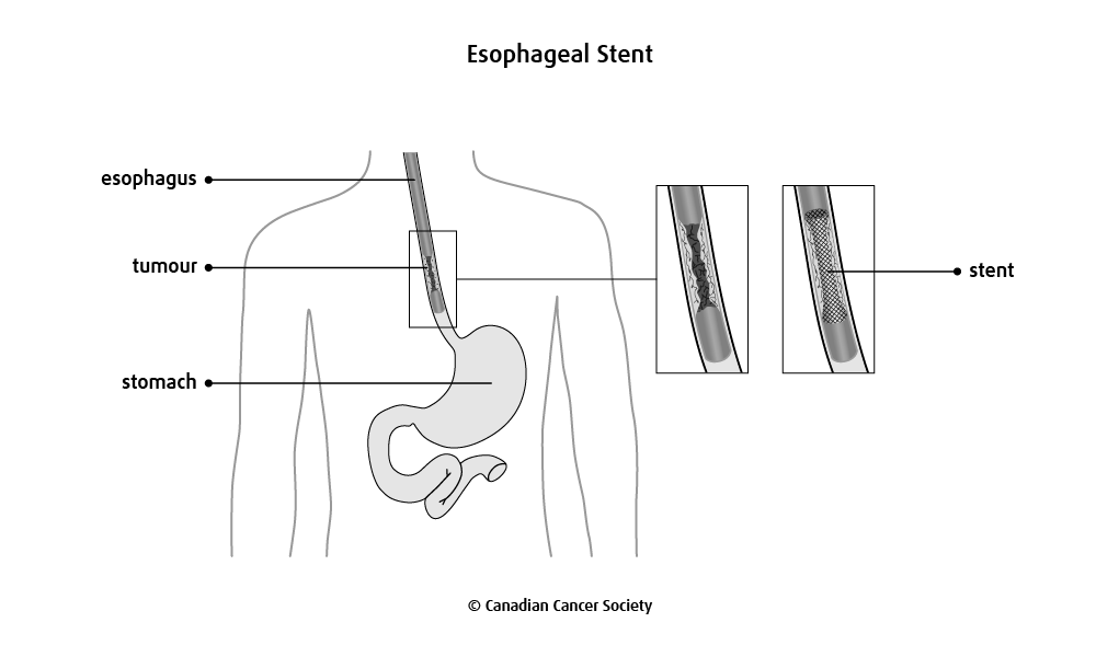 Diagram of an esophageal stent