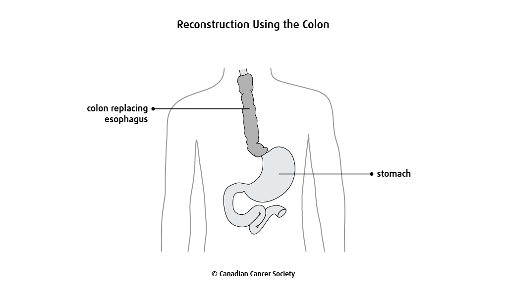 Diagram of reconstruction using the colon