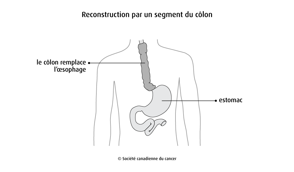 Schéma de la reconstruction par un segment du côlon