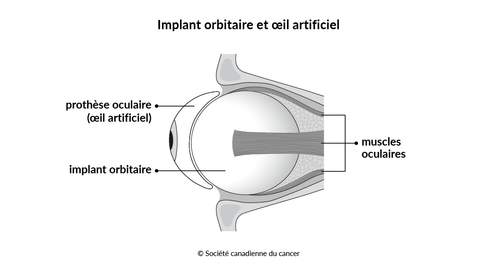 Schéma de l’implant orbitaire et de la prothèse oculaire (œil artificiel)