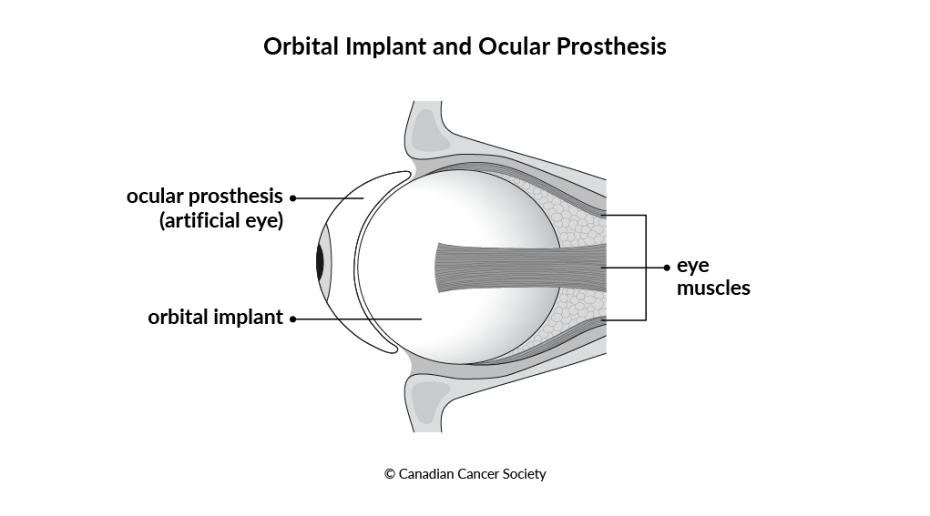 Diagram of an orbital implant and ocular prosthesis (artificial eye)