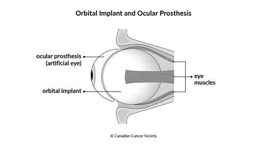 Diagram of an orbital implant and ocular prosthesis (artificial eye)