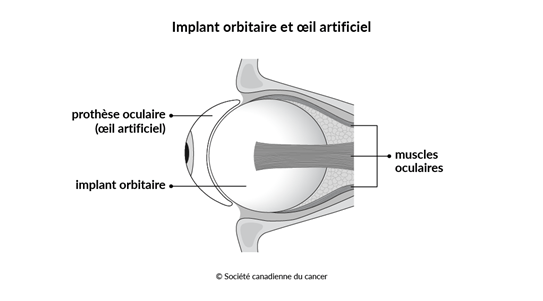 Schéma de l’implant orbitaire et de la prothèse oculaire (œil artificiel)