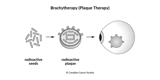 Diagram of eye brachytherapy (plaque therapy)