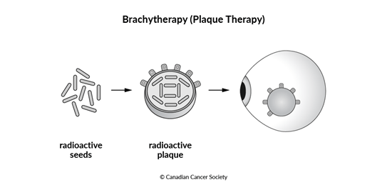 Diagram of eye brachytherapy (plaque therapy)