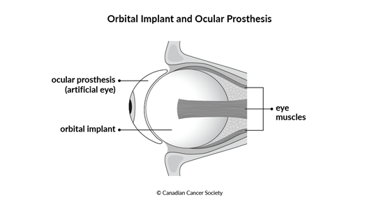 Diagram of an orbital implant and ocular prosthesis (artificial eye)