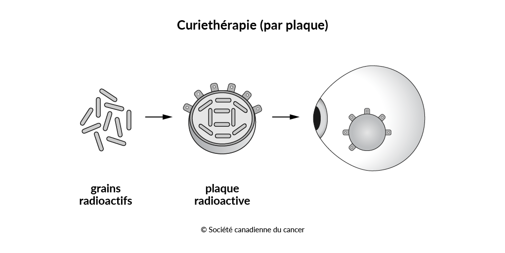 Schéma de la curiethérapie (radiothérapie par plaque) de l’œil