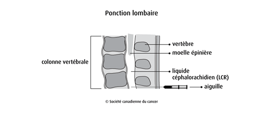 Schéma de la ponction lombaire