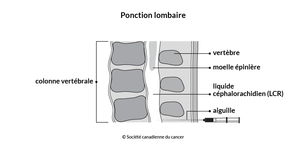  Schéma de la ponction lombaire 