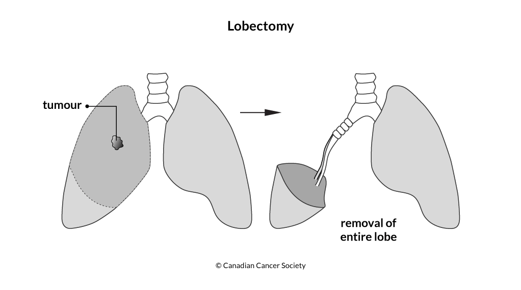 Diagram of a lobectomy