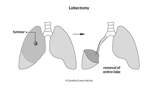 Diagram of a lobectomy