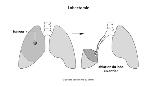 Schéma de la lobectomie