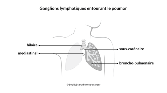 Schéma des ganglions lymphatiques entourant le poumon