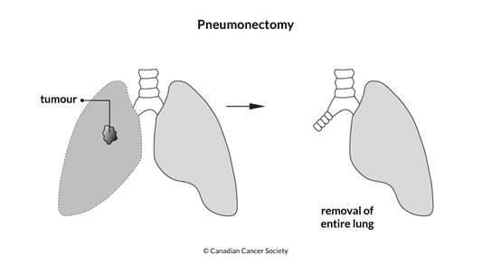 Diagram of a pneumonectomy