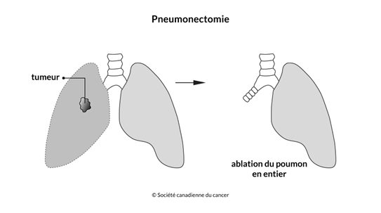 Schéma d'une pneumonectomie