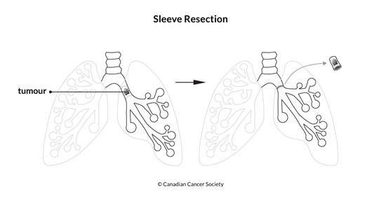 Diagram of a sleeve resection