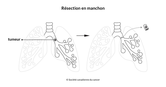 Chirurgie Du Cancer Du Poumon Non A Petites Cellules Societe Canadienne Du Cancer Chirurgie Du Cancer Du Poumon Non A Petites Cellules Societe Canadienne Du Cancer