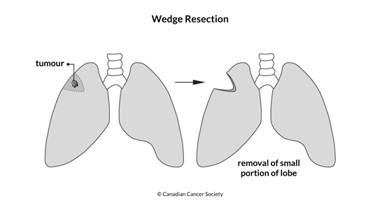 Diagram of a wedge resection