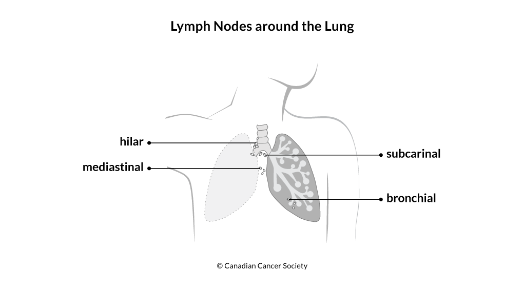 Diagram of the lymph nodes around the lung