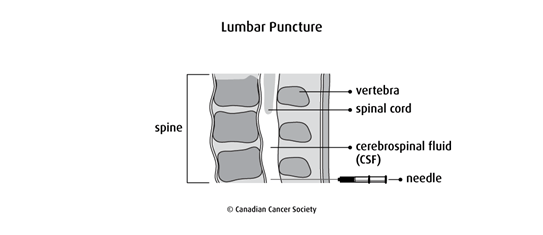 Diagram of a lumbar puncture