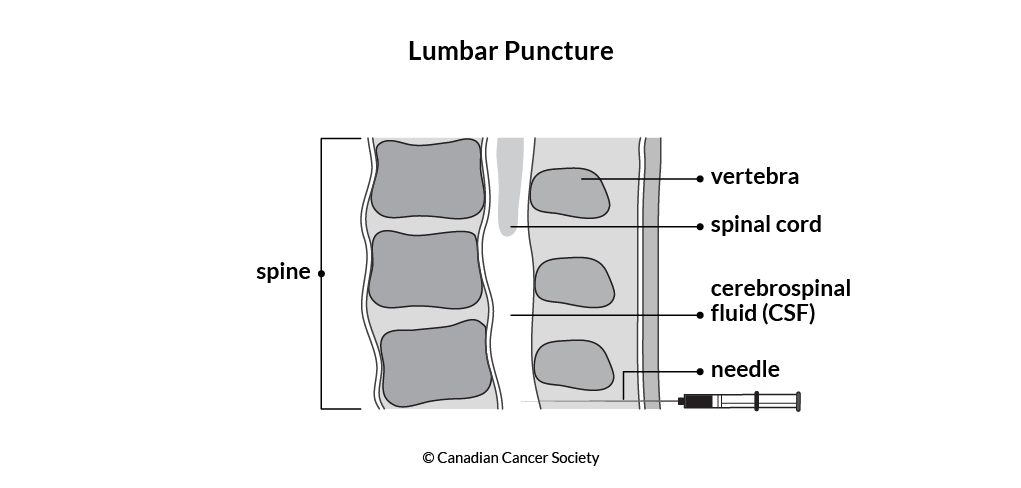 Diagram of a lumbar puncture
