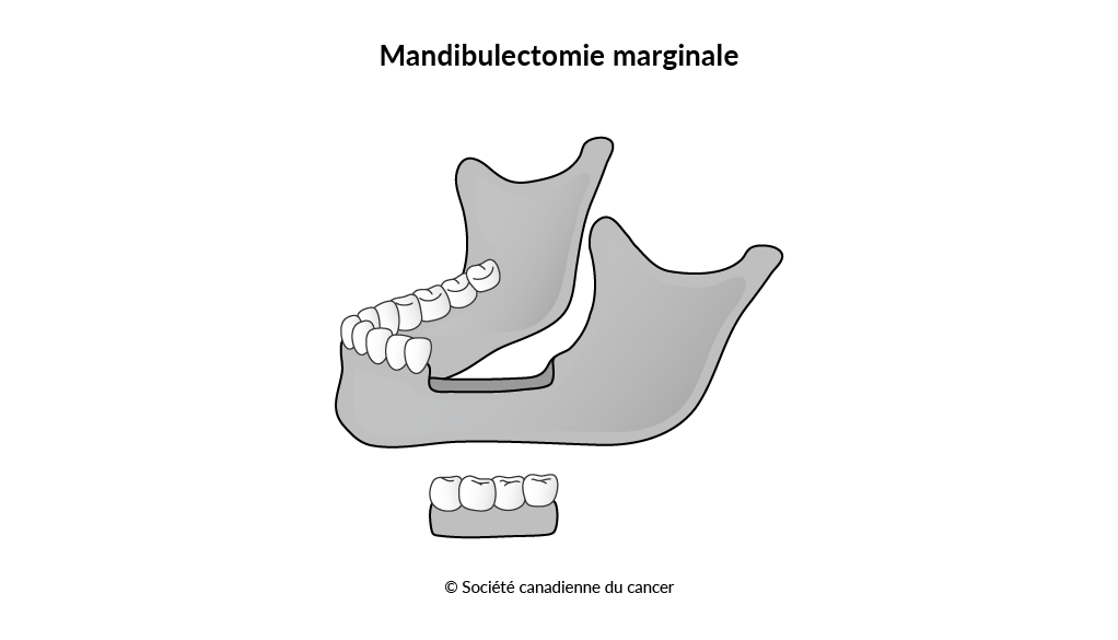 Schéma de la mandibulectomie marginale