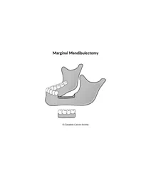 Diagram of marginal mandibulectomy