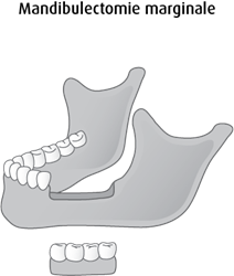 Schéma de la mandibulectomie marginale