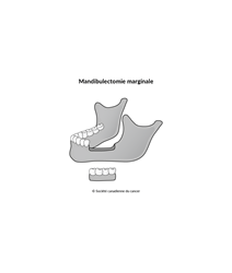 Schéma de la mandibulectomie marginale