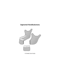 Diagram of segmental mandibulectomy