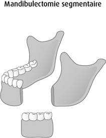 Schéma de la mandibulectomie segmentaire